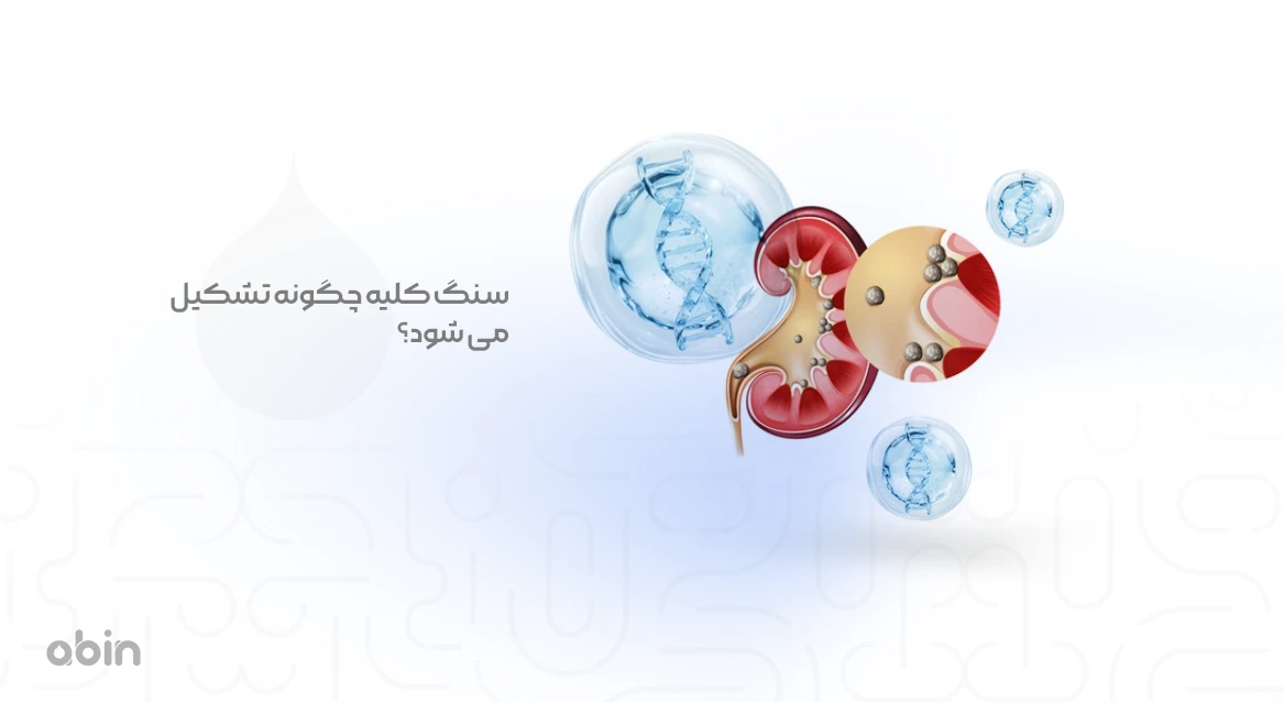 تصویر نمادین نحوه تشکیل سنگ کلیه